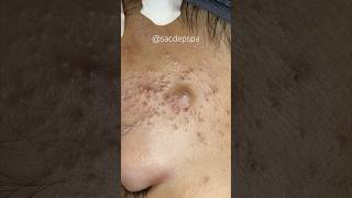 Blackheads blackheads treatments sacdepspa [upl. by Llertak]