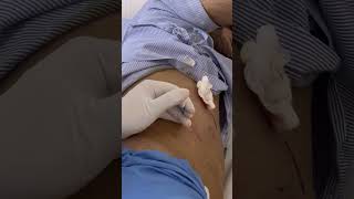 LIVER ABSCESS DRAIN  PERCUTANEOUS CATHETER DRAINAGE OF LIVER ABSCESS PIGTAIL CATHETER  Dr Raj [upl. by Innavoij]