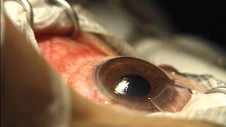 Chirurgie réfractive correction de la myopie Lasik [upl. by Daph]