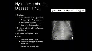 Cases 134 Hyaline MembraneDisease HMD [upl. by Bullion]