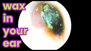 asmr ear cleaning  wax in your ear  Ear health  ear piercing cleaning how to unclog your ear [upl. by Annahs]