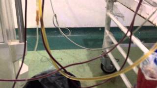 Plasmapheresis in Renal transplant with severe AMR Dr Sandeep kumar garg [upl. by Retrop]