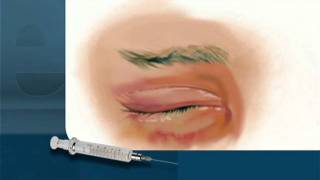 Botox Injections by Unlicensed Practitioners [upl. by Ulphia187]