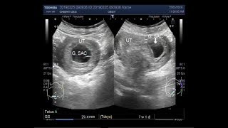 Ultrasound Video showing Pregnancy with Blighted Ovum [upl. by Ninazan486]