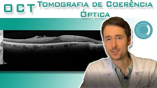 OCT  Tomografia de Coerência Óptica  Canal Retina e Vítreo [upl. by Neih]