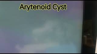 Arytenoid Cyst [upl. by Nave]