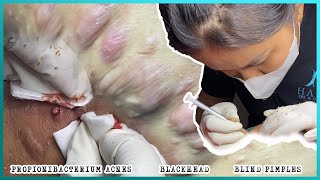 Big Cystic Acne Blackheads Extraction Blackheads amp Milia Whiteheads Removal Pimple Popping [upl. by Htepsle820]