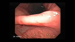 Video clip of an Upper Endoscopy [upl. by Htebsil]