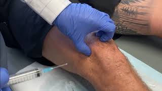 KNEE Intraarticular injection of Local Anaesthetic and Steroid [upl. by Oneladgam]