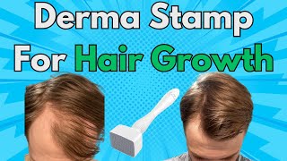 This Is Why You Should Add A Derma Stamp To Your Hair Growth Routine  Derma Stamp x Minoxidil Combo [upl. by Egan]