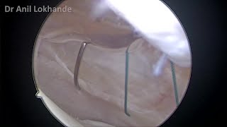 Arthroscopic Medial Retinaculum Plication amp Lateral Release Patella by Dr Anil Lokhande [upl. by Lari]