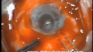 Limbal SCC Excision [upl. by Allehc440]