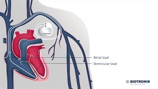 How pacemakers work  Medical Animation [upl. by Anniahs]