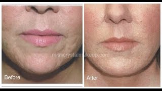 Juvederm Filler For Acne Scars [upl. by Scibert]