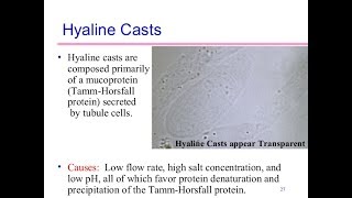 Hyaline cast [upl. by Berke104]