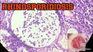 Rhinosporidiosis Histopathology [upl. by Juliano]