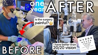 I had laser eye surgery at the best clinic in London  1 year review SMILE surgery [upl. by Essie936]