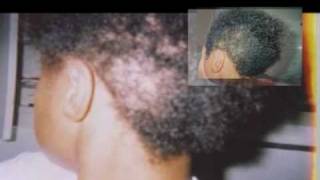 Reverse Traction Alopecia ReGrow Your Hair Naturally [upl. by Tarsus]