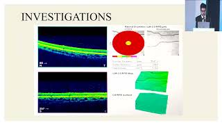 AIOC2024 GP199 topic Dr Markandeya Singh Foveal Aplasia [upl. by Omrelliug]