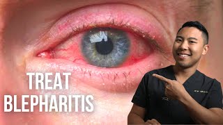 How to treat blepharitis 3 ScienceBacked Ways  OphthalmologistMichaelRChuaMD [upl. by Forta74]