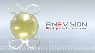 FineVision Trifocal Intraocular Lens [upl. by Yanahs]