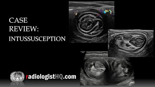 Ultrasound of Intussusception [upl. by Eillil]