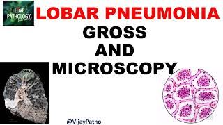 Lobar Pneumonia  Pathology  Gross and Microscopy  Illustration  Draw With Me [upl. by Justine]