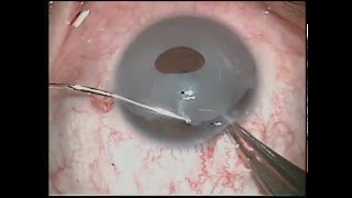 Eye Color Change New iris Implant removal exhanged to Brightocular [upl. by Adnilre]