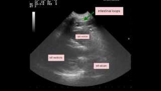 Peritoneopericardial Diaphragmatic Hernia PPDH [upl. by Fabriane]