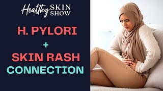 H pyloriSkin Rash CONNECTION  Jennifer Fugo [upl. by Schumer]