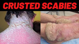 What is CRUSTED Scabies Norwegian Scabies Symptoms Causes Common Areas Treatment [upl. by Eey]