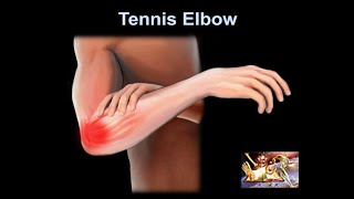 Tennis Elbow why it hurts Everything You Need To Know  Dr Nabil Ebraheim [upl. by Pinsky]