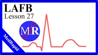 Left Anterior Fascicular Block LAFB [upl. by Nur]