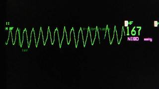 ventricular tachycardia  Torsade de Pointes on an ECG heart monitor [upl. by Nnyleve]