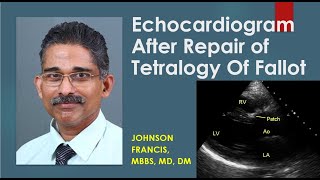 Echocardiogram After Repair of Tetralogy Of Fallot [upl. by Cordelie]