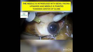 INTRAVITREAL INJECTION IN PSEUDOPHAKIC EYE [upl. by Danyette437]