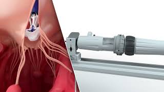 PASCAL Precision System – Implantation of the device in the mitral and tricuspid valves  Animation [upl. by Ora]