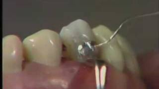 Class V Amalgam Restoration Finishing and Polishing [upl. by Afatsum]