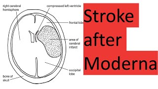 Stroke and death after Moderna [upl. by Lapointe81]