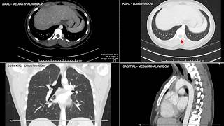 Introduction to Computed Tomographic imaging of the Chest [upl. by Qidas]