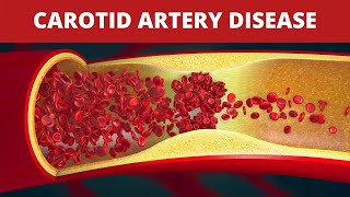 Treatment of Carotid Artery Disease [upl. by Eiralc]