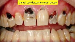 Teeth cavitiescariestooth decay [upl. by Moffat]