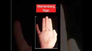 Wartenberg sign ytshorts neurology health [upl. by Barbarese]