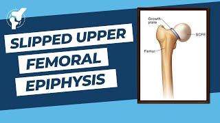 Slipped Capital Femoral Epiphysis  SUFE  SCFE   How to Prevent Avascular Necrosis [upl. by Cormier]