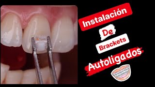 Instalación de Brackets Autoligados Estéticos 💎 [upl. by Lemkul]