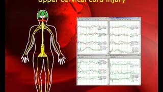 quotPatient Transparentquot Intraoperative Neurophysiological Monitoring in MISS [upl. by Deva260]