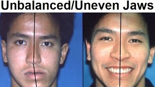 Orthodontic Treatment of Asymmetrical Unbalanced Disproportionate or Unequal Jaw by Dr Mike Mew [upl. by Ody]