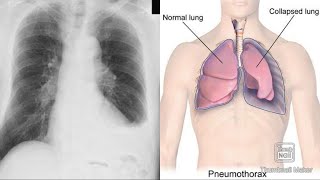 Pleurisy Pleural effusion Pneumothorax Hydropneumothorax Empyema Hemothorax clinicalAnatomy [upl. by Ver96]