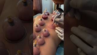 Hijama cupping therapy [upl. by Lorn]