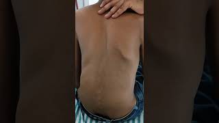 Kyphoscoliosis in a Case of Marfans Syndrome [upl. by Redienhcs936]